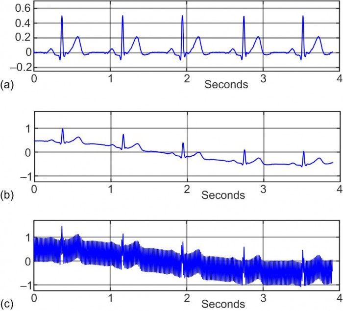 60Hz Noise and Baseline Drift Reduction in ECG Signal Processing